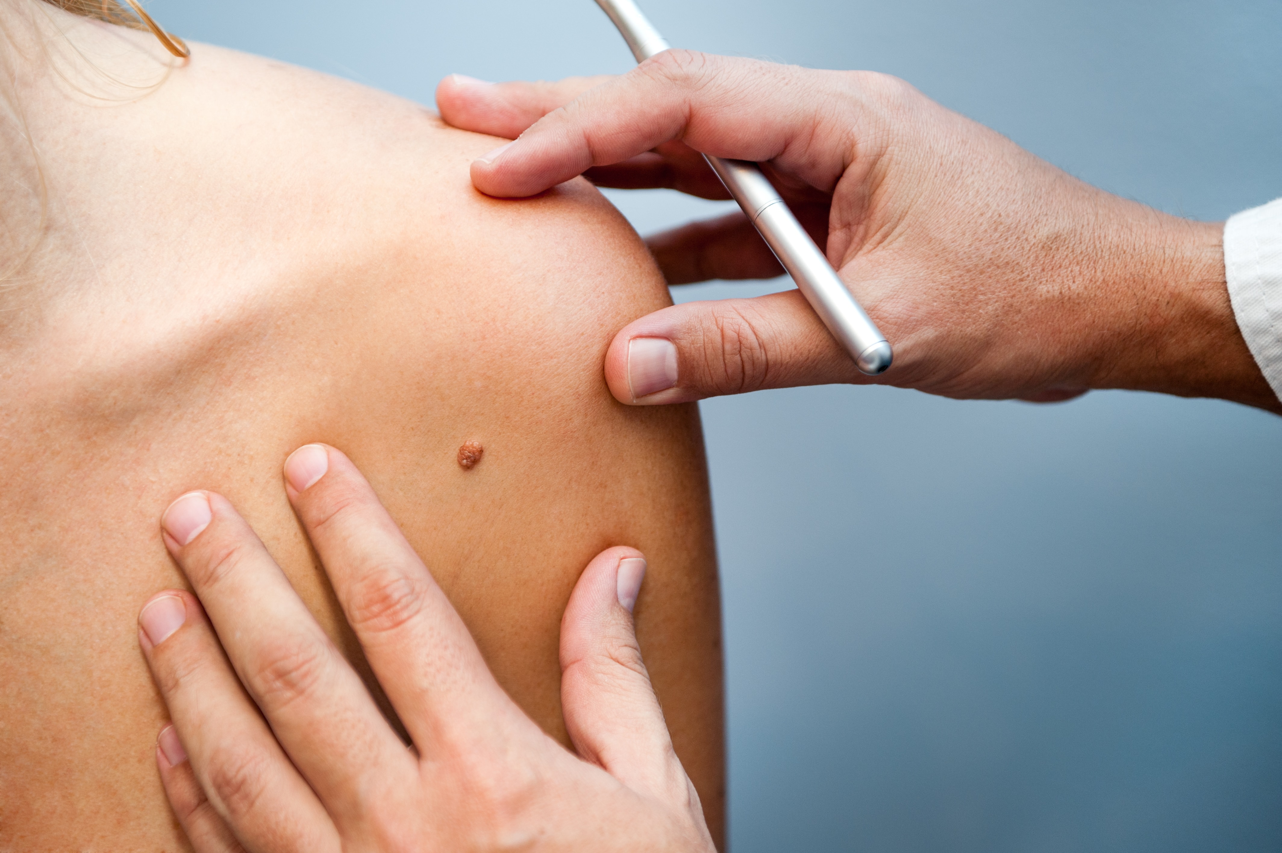 woman getting mole checked by doctor